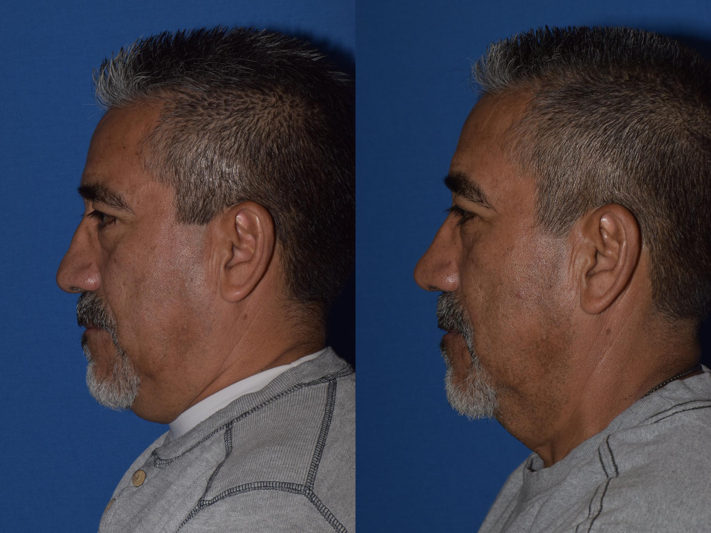 Before & After Rhinoplasty Case 7 Left Side View in South Miami, Florida