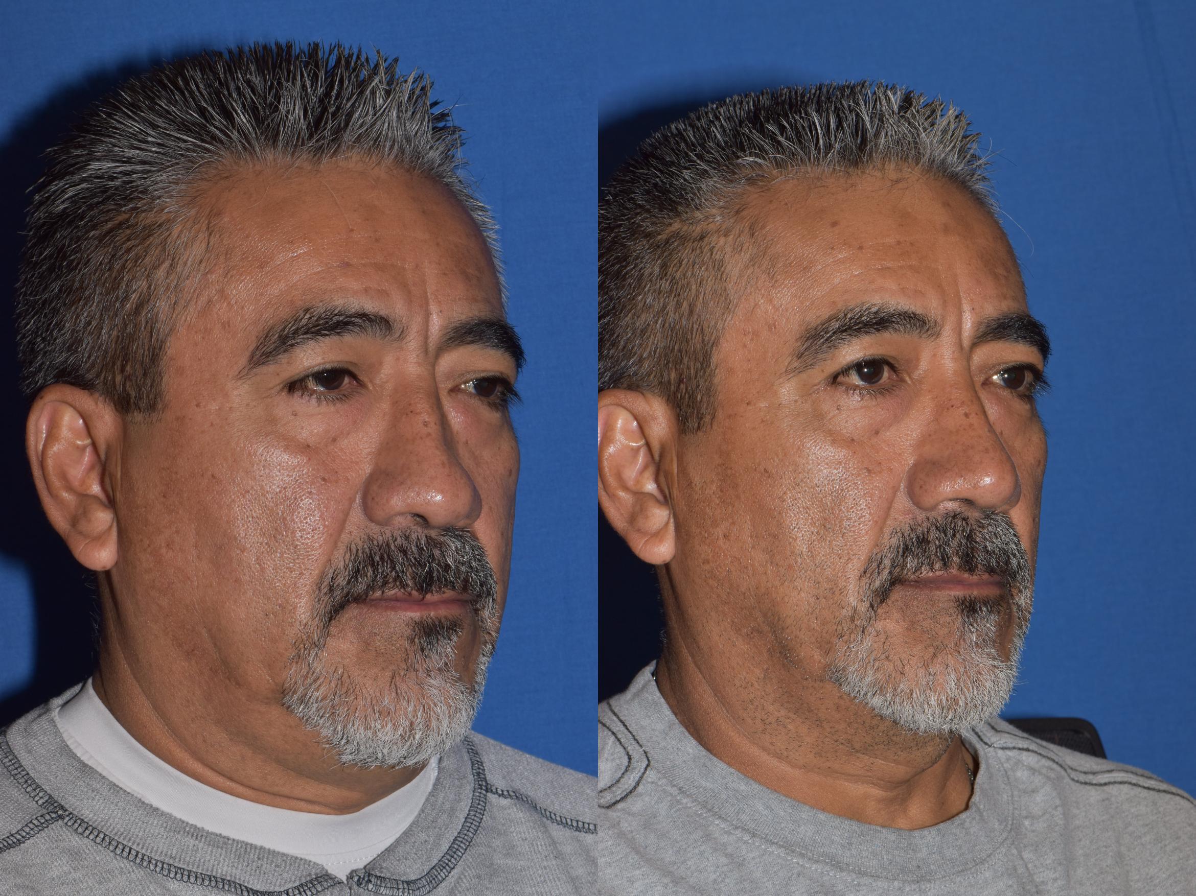 Before & After Rhinoplasty Case 7 Right Oblique View in South Miami, Florida