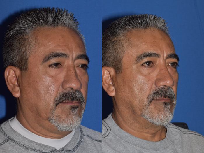 Before & After Rhinoplasty Case 7 Right Oblique View in South Miami, Florida
