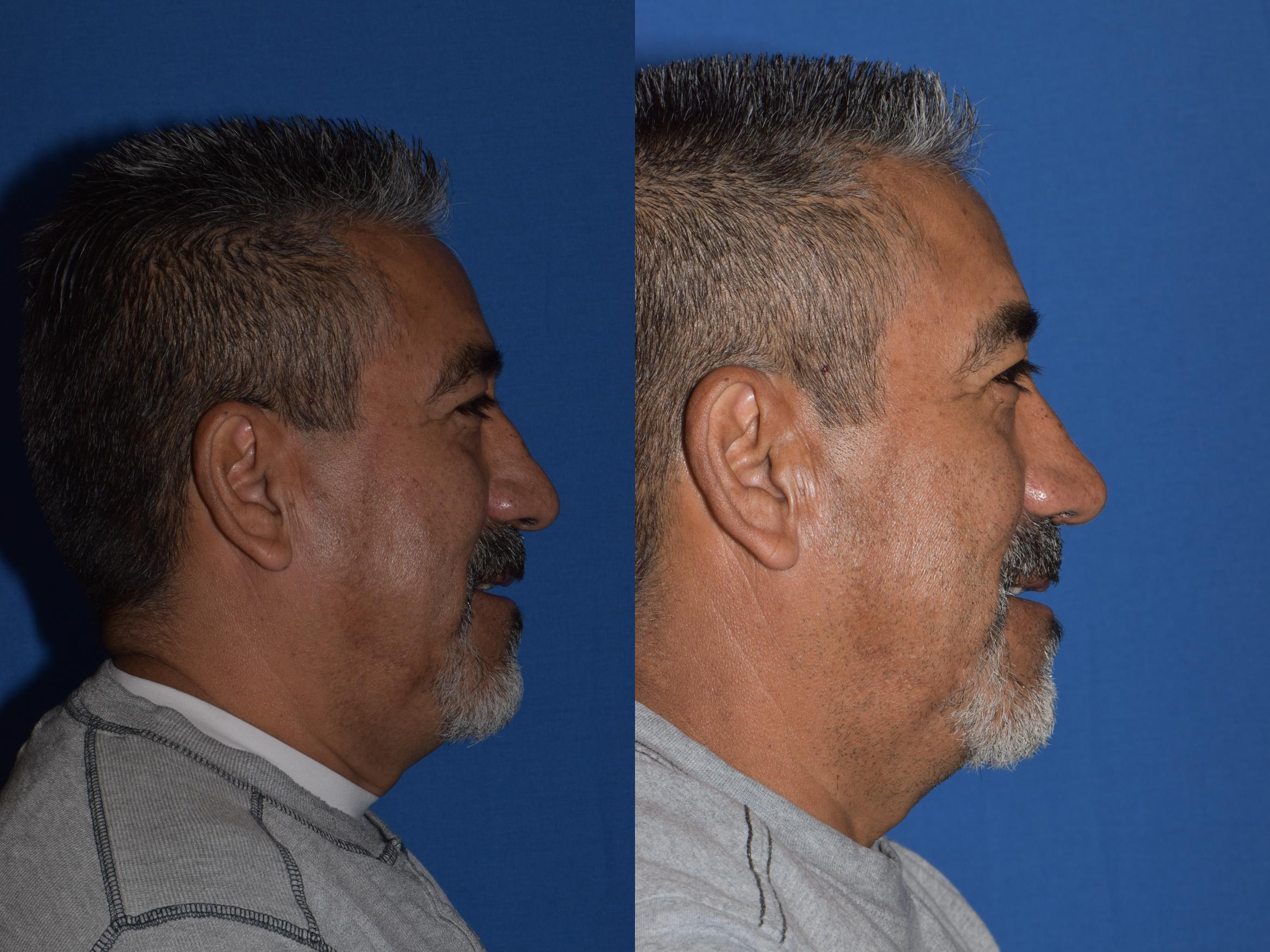 Before & After Rhinoplasty Case 7 Right Side Smiling View in South Miami, Florida