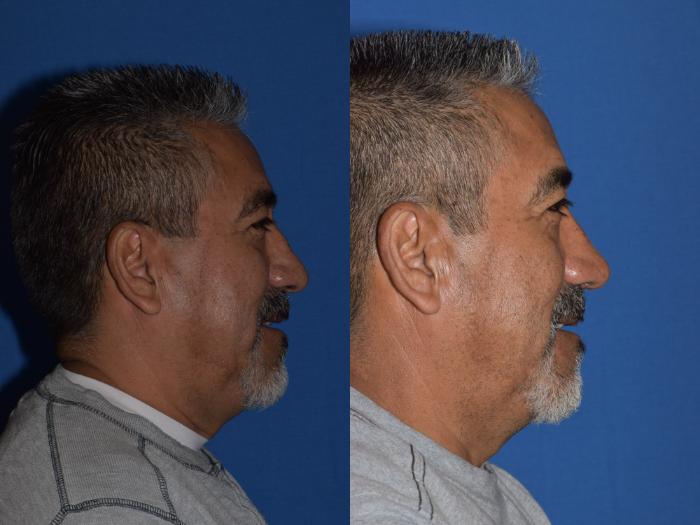 Before & After Rhinoplasty Case 7 Right Side Smiling View in South Miami, Florida