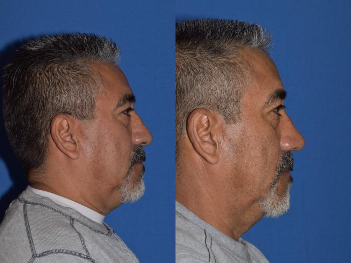 Before & After Rhinoplasty Case 7 Right Side View in South Miami, Florida