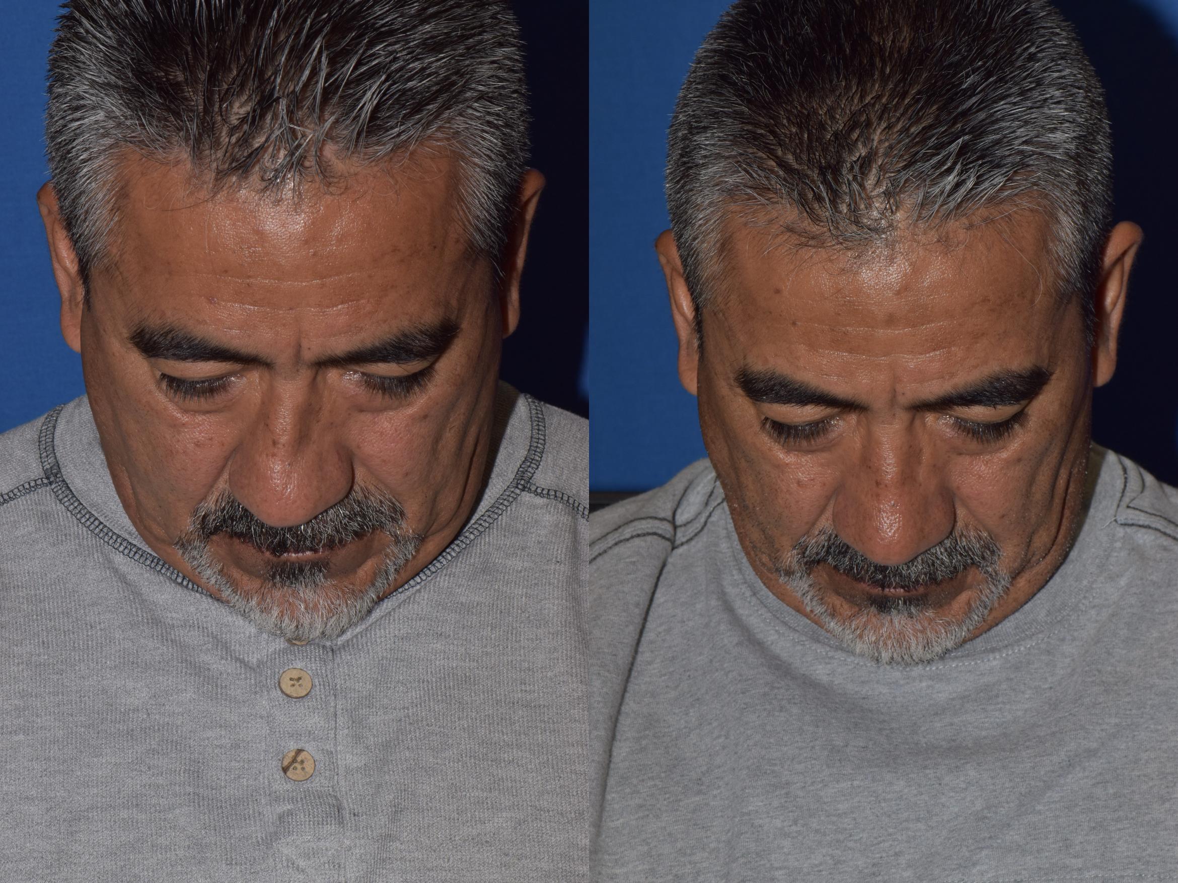 Before & After Rhinoplasty Case 7 Top View in South Miami, Florida