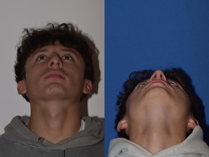 Before & After Rhinoplasty Case 8 Bottom View in South Miami, Florida