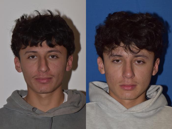 Before & After Rhinoplasty Case 8 Front View in South Miami, Florida