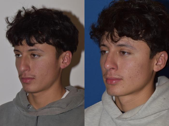 Before & After Rhinoplasty Case 8 Left Oblique View in South Miami, Florida