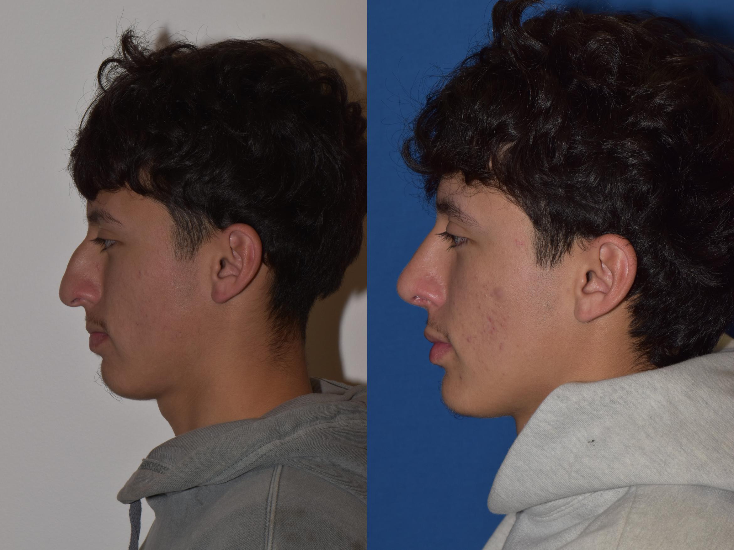 Before & After Rhinoplasty Case 8 Left Side View in South Miami, Florida