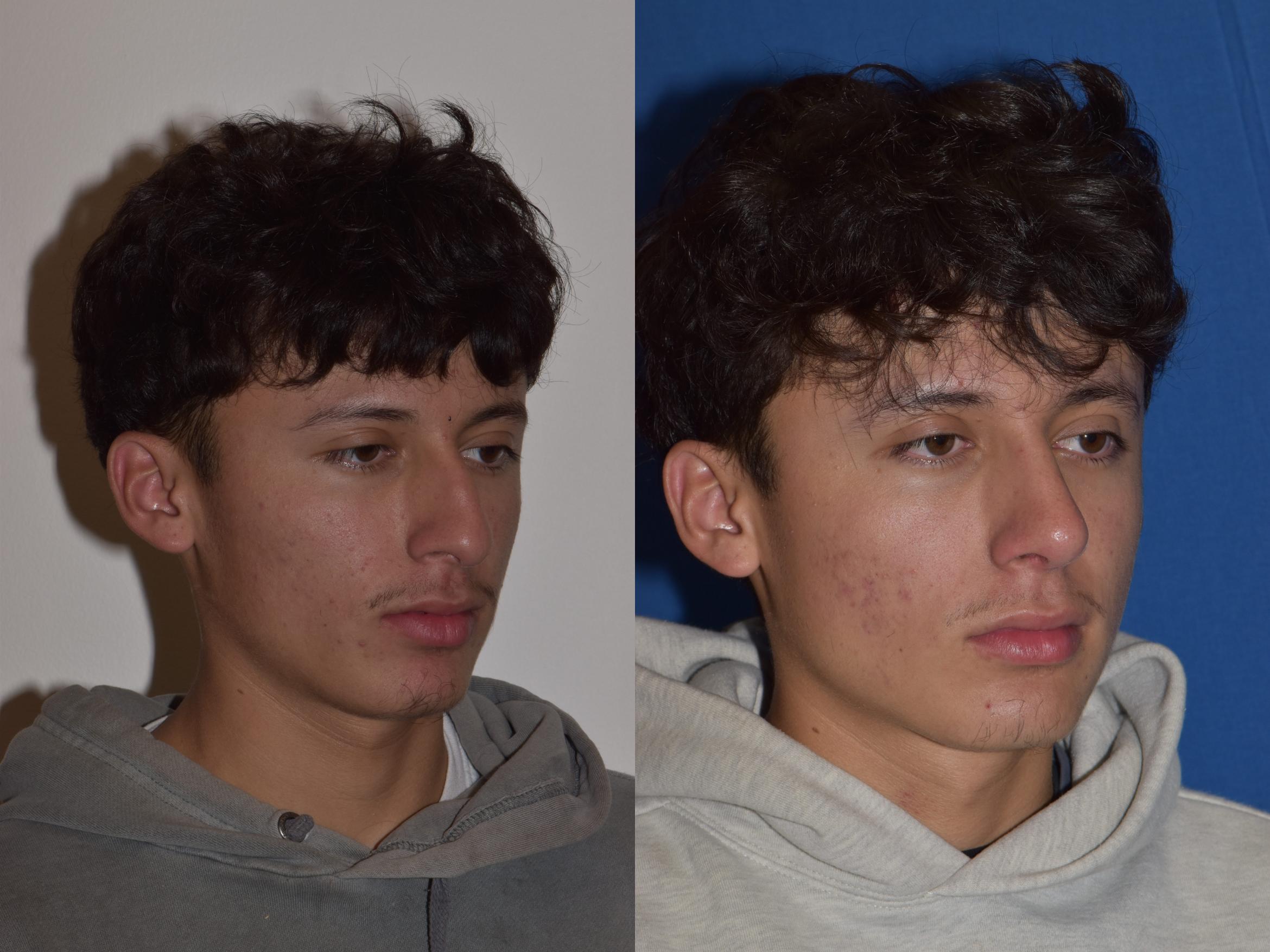 Before & After Rhinoplasty Case 8 Right Oblique View in South Miami, Florida