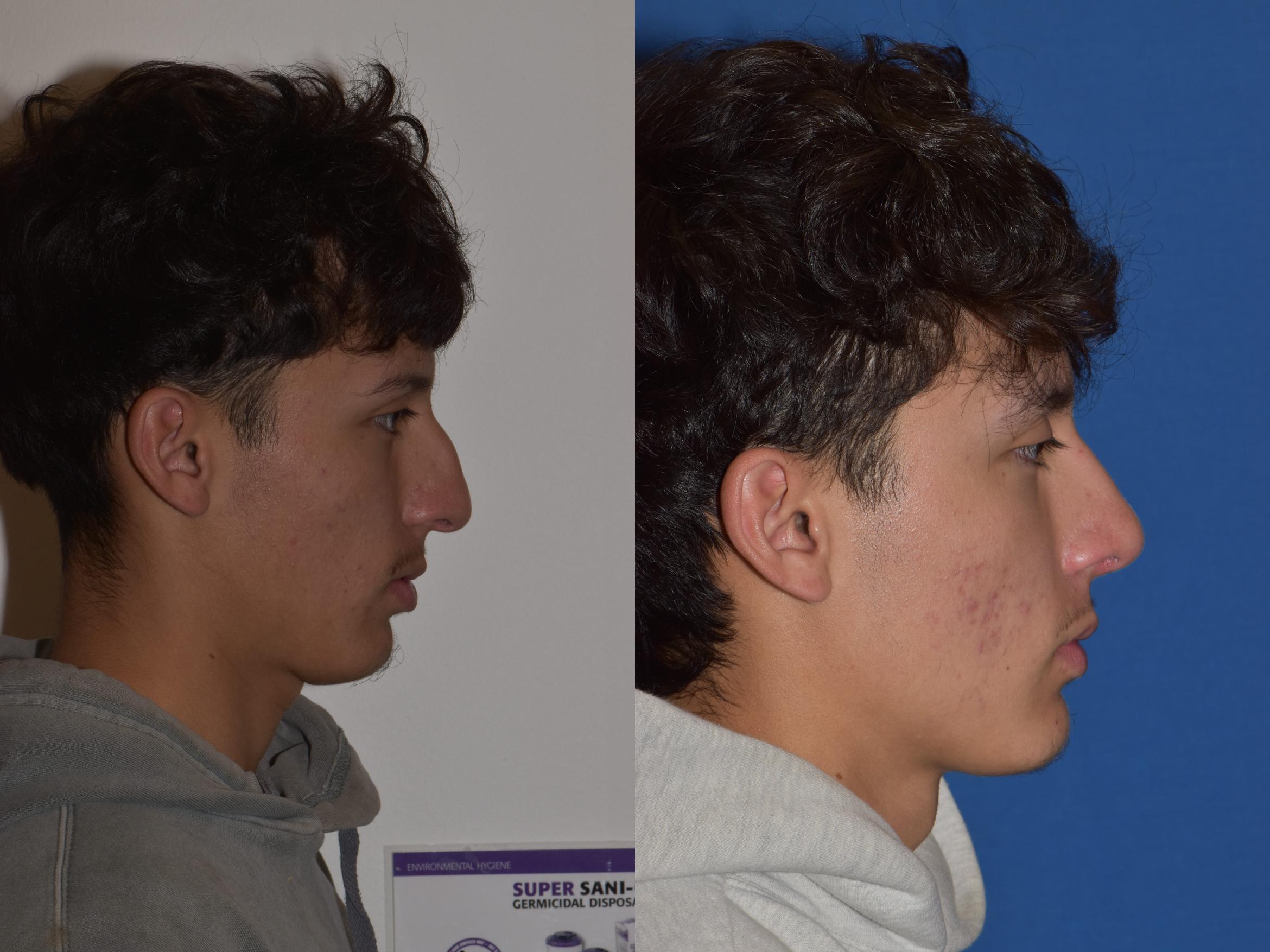 Before & After Rhinoplasty Case 8 Right Side View in South Miami, Florida