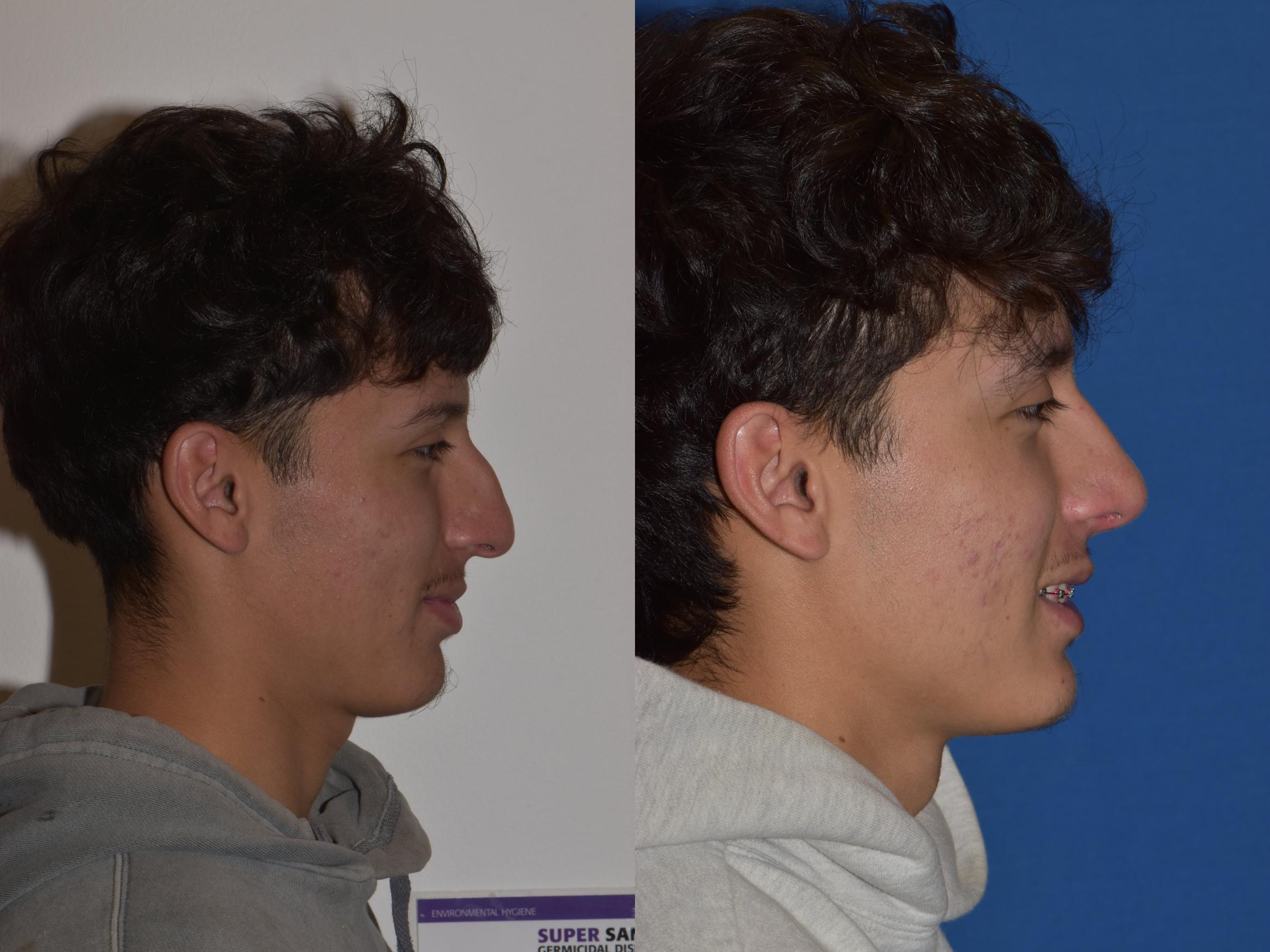Before & After Rhinoplasty Case 8 Right Side Smiling View in South Miami, Florida