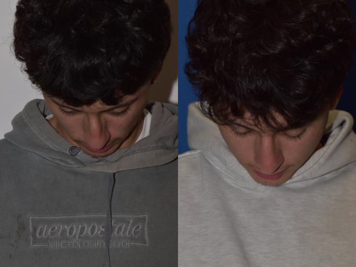 Before & After Rhinoplasty Case 8 Top View in South Miami, Florida