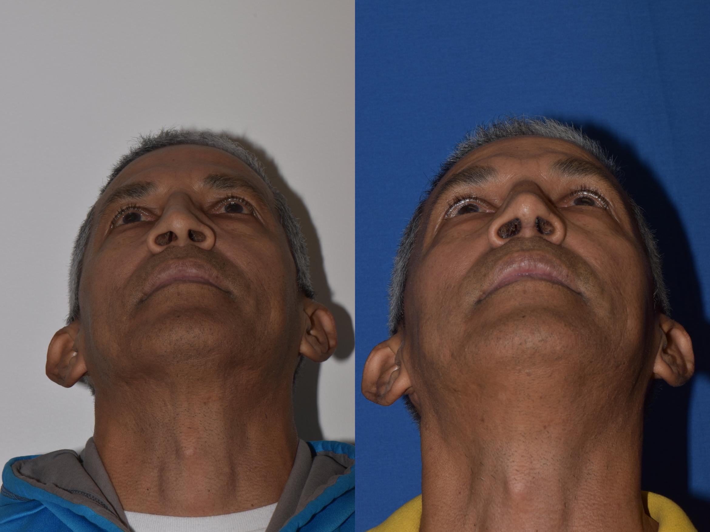 Before & After Rhinoplasty Case 9 Bottom View in South Miami, Florida