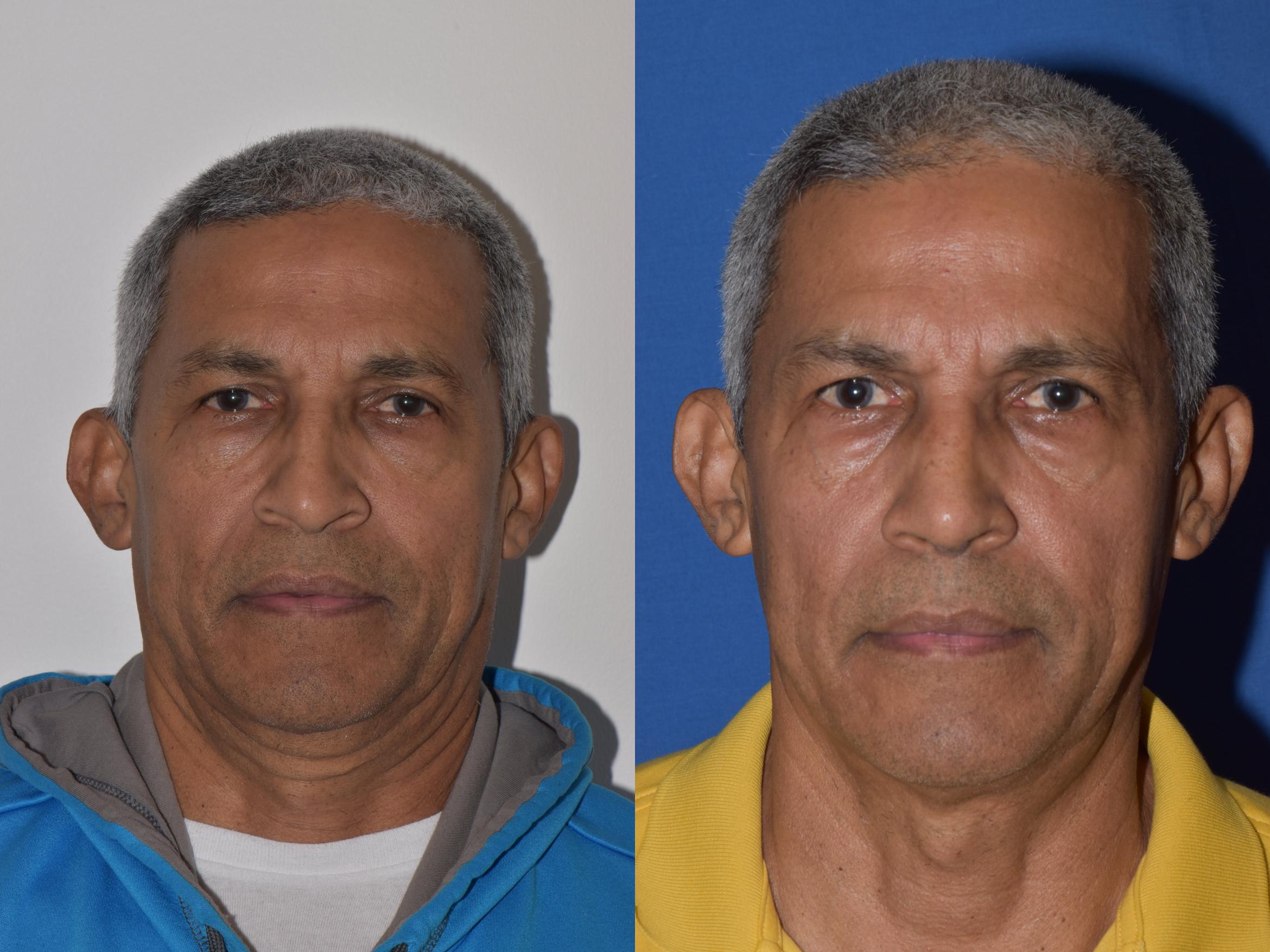 Before & After Rhinoplasty Case 9 Front View in South Miami, Florida