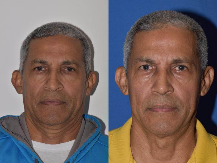 Before & After Rhinoplasty Case 9 Front View in South Miami, Florida
