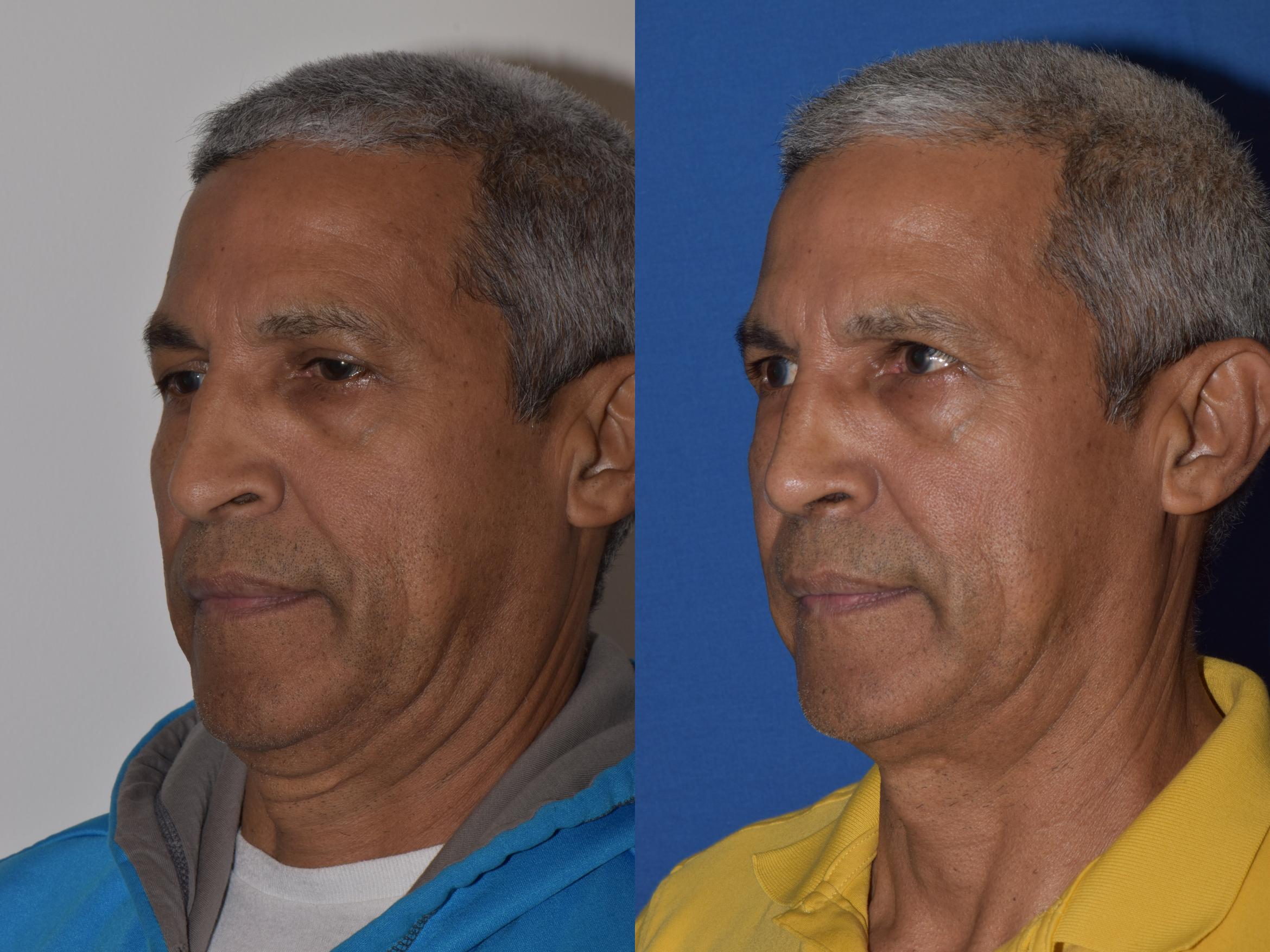 Before & After Rhinoplasty Case 9 Left Oblique View in South Miami, Florida