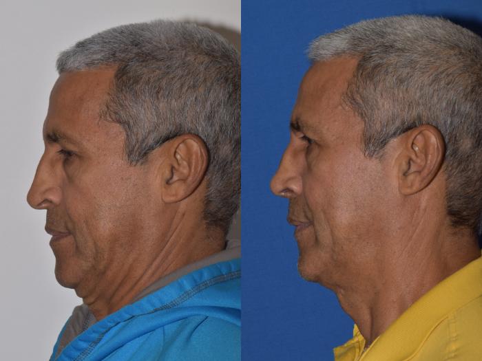 Before & After Rhinoplasty Case 9 Left Side View in South Miami, Florida