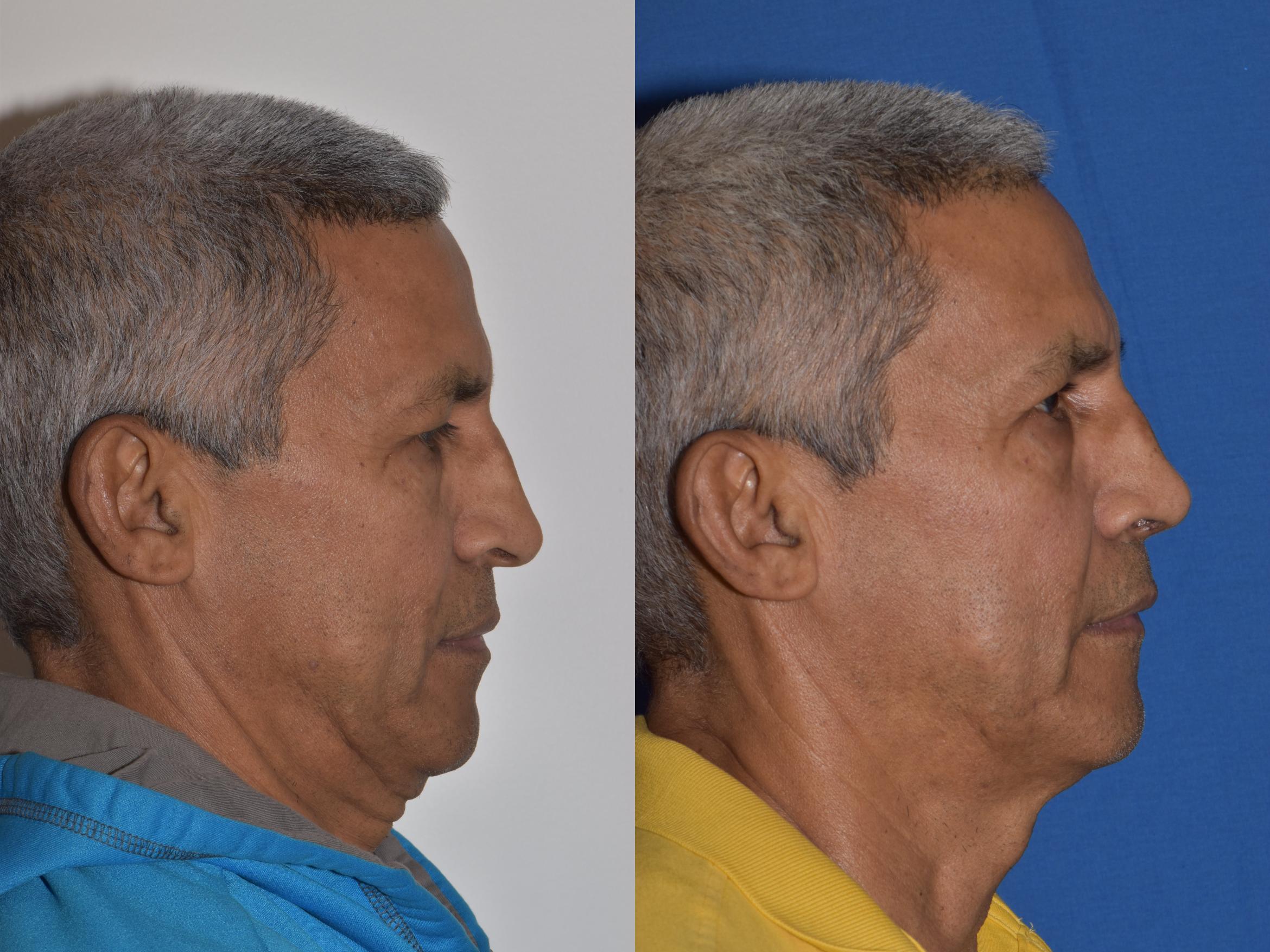 Before & After Rhinoplasty Case 9 Right Side View in South Miami, Florida