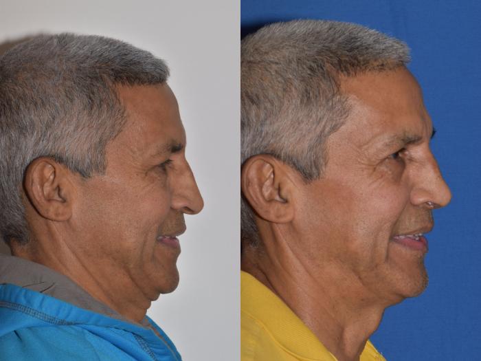 Before & After Rhinoplasty Case 9 Right Side Smiling View in South Miami, Florida