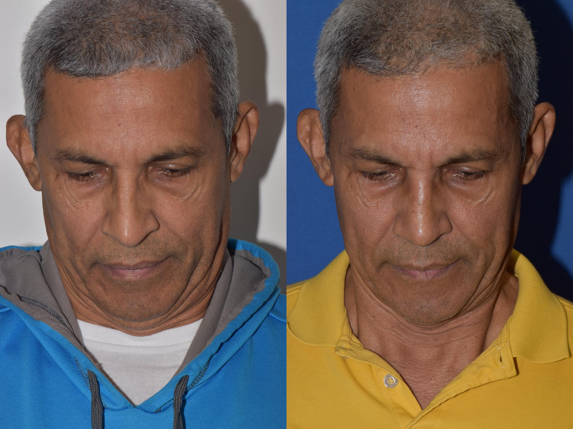 Before & After Rhinoplasty Case 9 Top View in South Miami, Florida